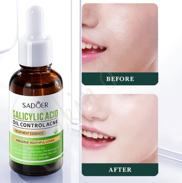 Sadoer Salycilic Acid Oil Control Acne Before After