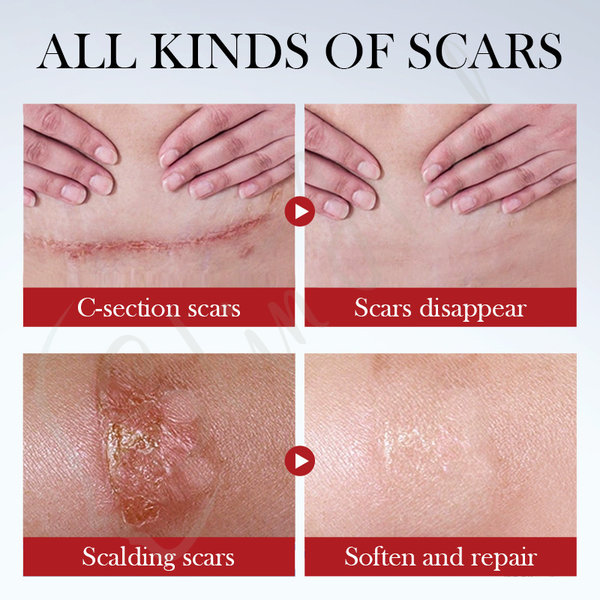 Scar-Repair-Serum-Before-After-Sadoer